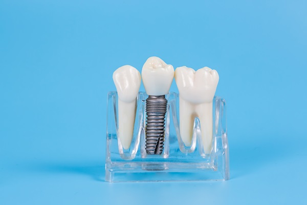 What Is The Purpose Of Dental Crowns?