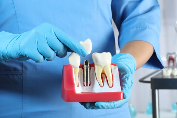 What To Ask Your Dentist About Dental Implants