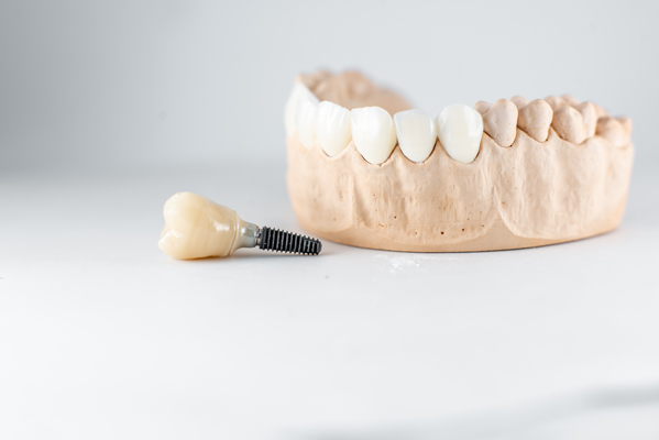 How To Properly Care For Dental Implants