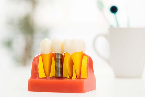 How Long Is The Process For Placing Implant Crowns?