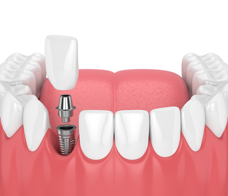 Implant Crowns Vs  Traditional Crowns: Key Differences Explained